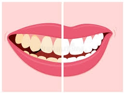 برای سفید تر شدن دندانها چه کنیم؟